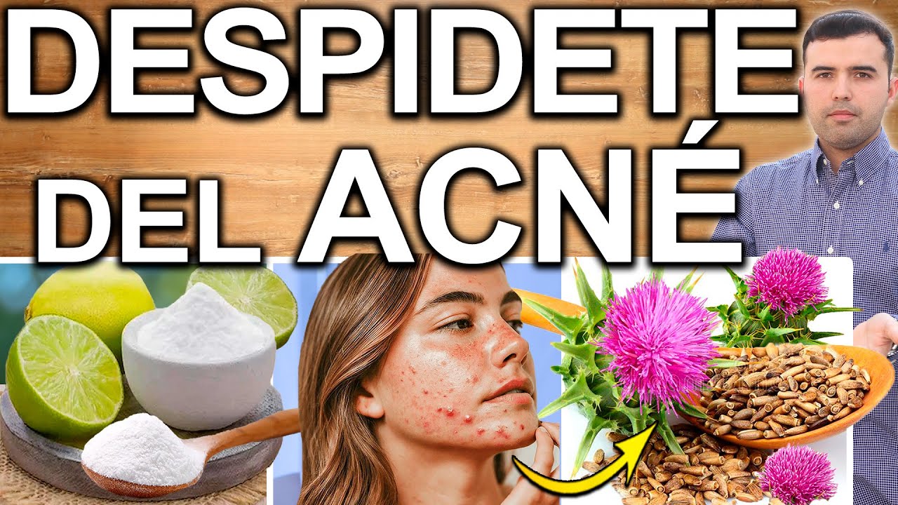ELIMINA EL ACNE PARA SIEMPRE - Como Eliminar Los Granos Espinillas y Curar El Acn&eacute; En 1 Semana