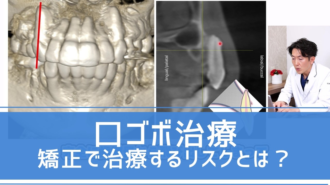 【口ゴボ治療】歯列矯正で歯が抜けるリスク！？「歯根逸脱」と「歯根吸収」を防ぐ方法  ～ カトレア歯科・美容クリニック