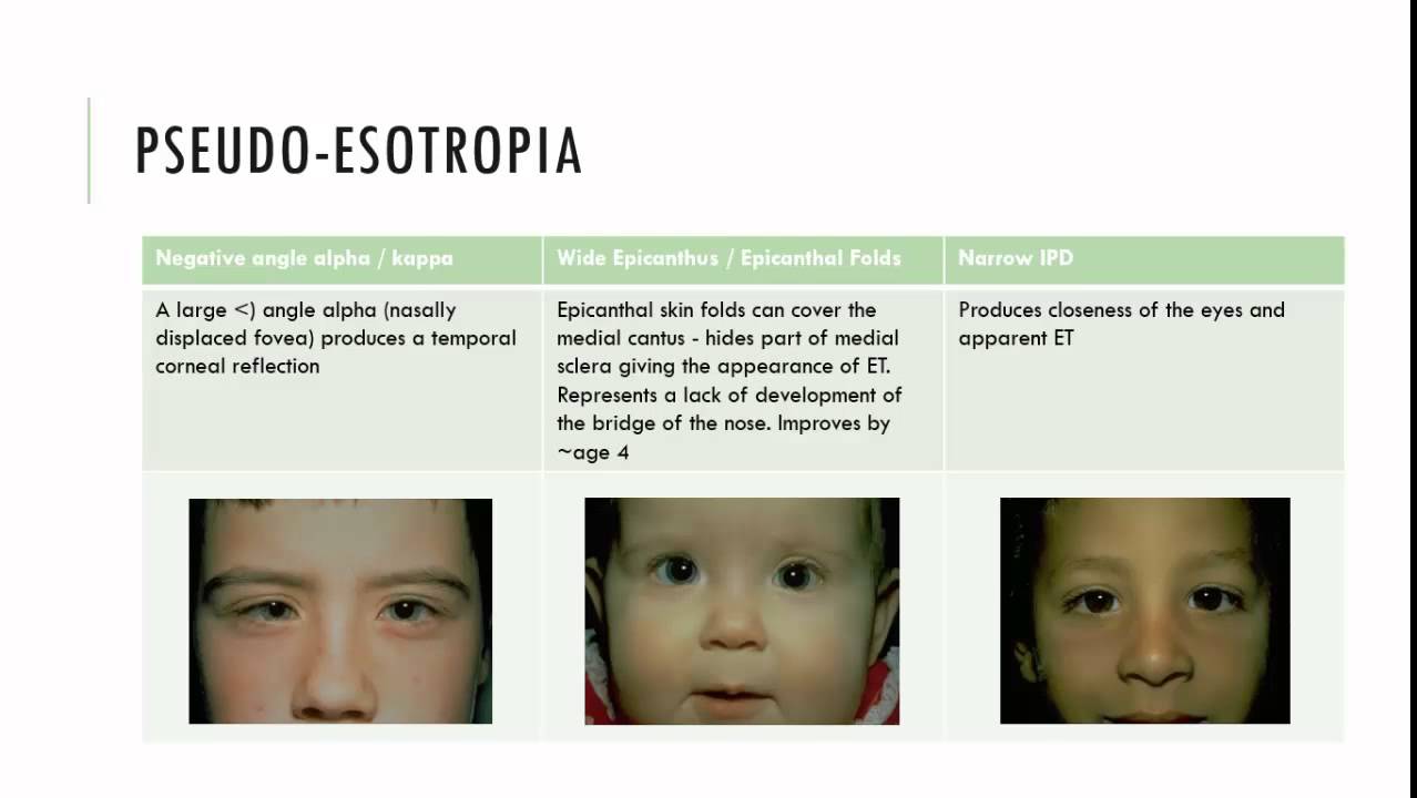 Pseudostrabismus Characteristics