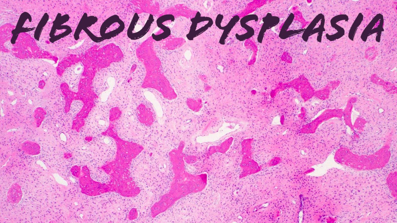 Fibrous dysplasia (bone pathology histology McCune Albright syndrome USMLE)