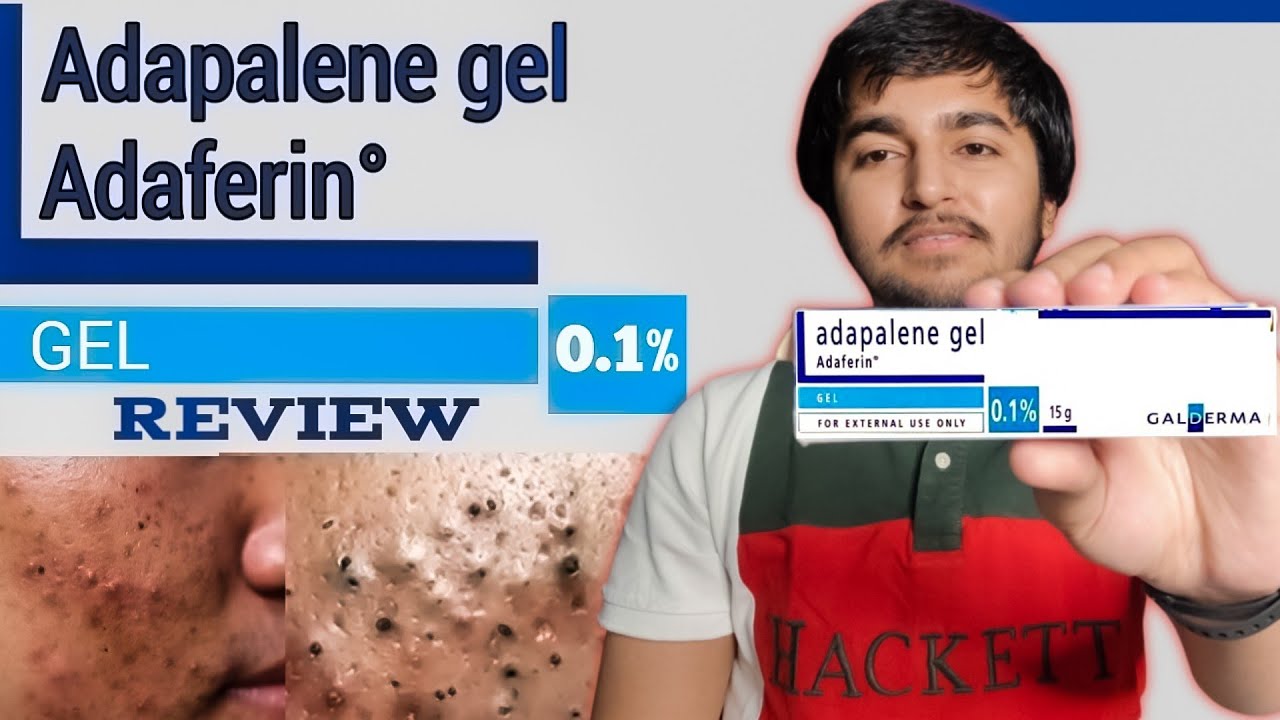 Adapalene Gel Adaferin 0.1 Review In Hindi | Gel For Blackheads and Whiteheads