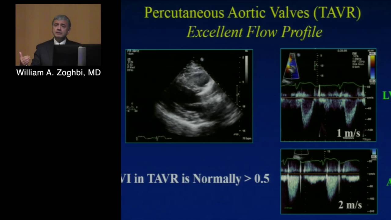 Prosthetic Valve Assessment (William A. Zoghbi, MD) April 29, 2016