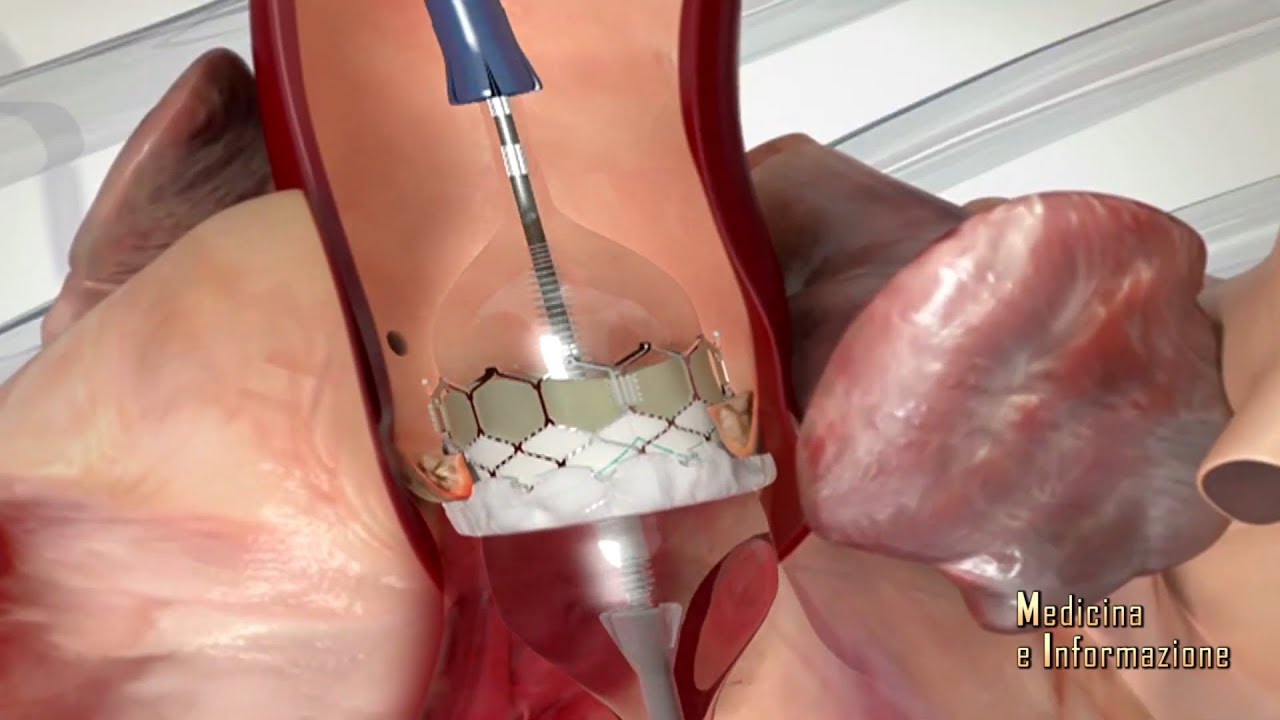 Cardiologia Interventistica: tecniche mininvasive  per le valvole cardiache