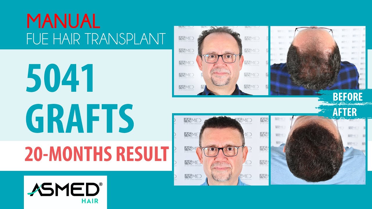 Manual FUE Saç Ekimi 5041 Greft 20 Aylık Sonuç #hairtransplant  #asmed