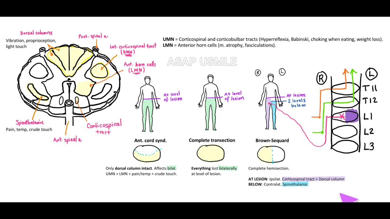 Spinal cord lesions, Spinothalamic tract, UMN and LMN, Brown-Sequard. As easy as it gets!