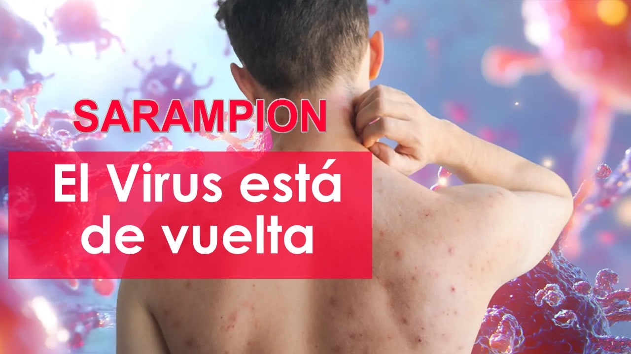 Asesoría Medica: Sarampión (Qué es y Cómo Prevenirlo) + Presentación  100% de Reembolso #ClubWeNow