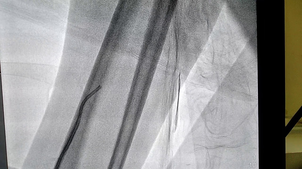 Radial artery loop