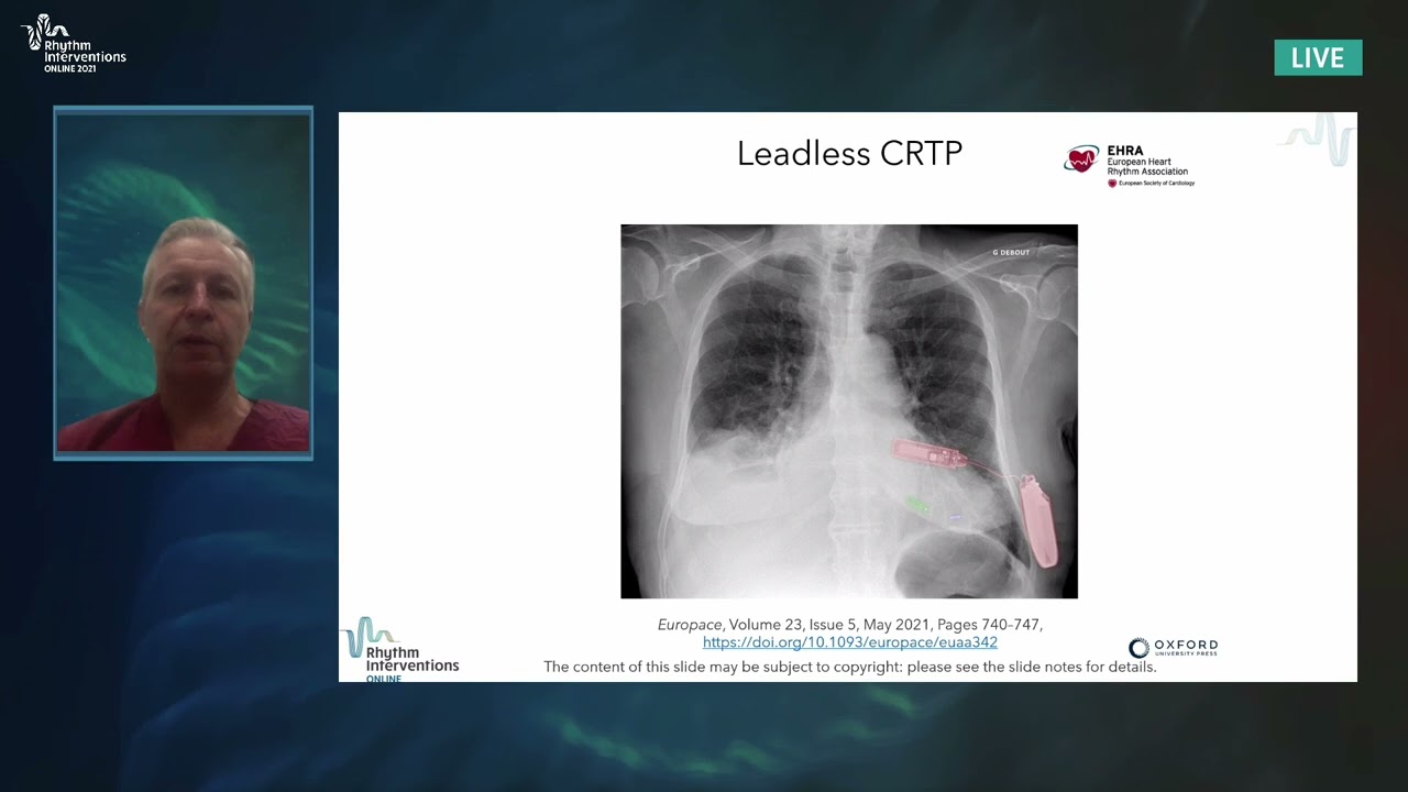 Presentation, Discussion & Event Wrap-up: Future of Leadless CRT Pacing