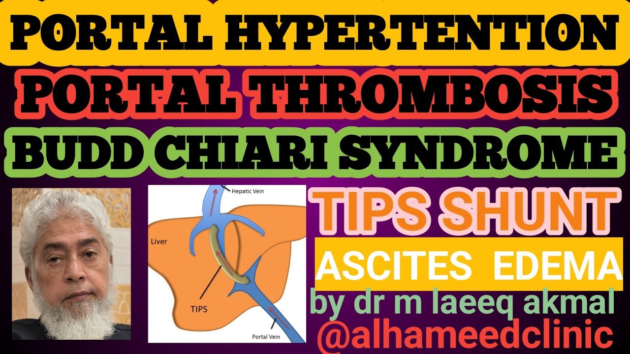 ARTERIAL HTN, PORTAL HTN, TIPS SHUNT ,PORTAL VEIN DOPPLER STUDIES , ASCITES, PARACENTESIS PORTA HEP.