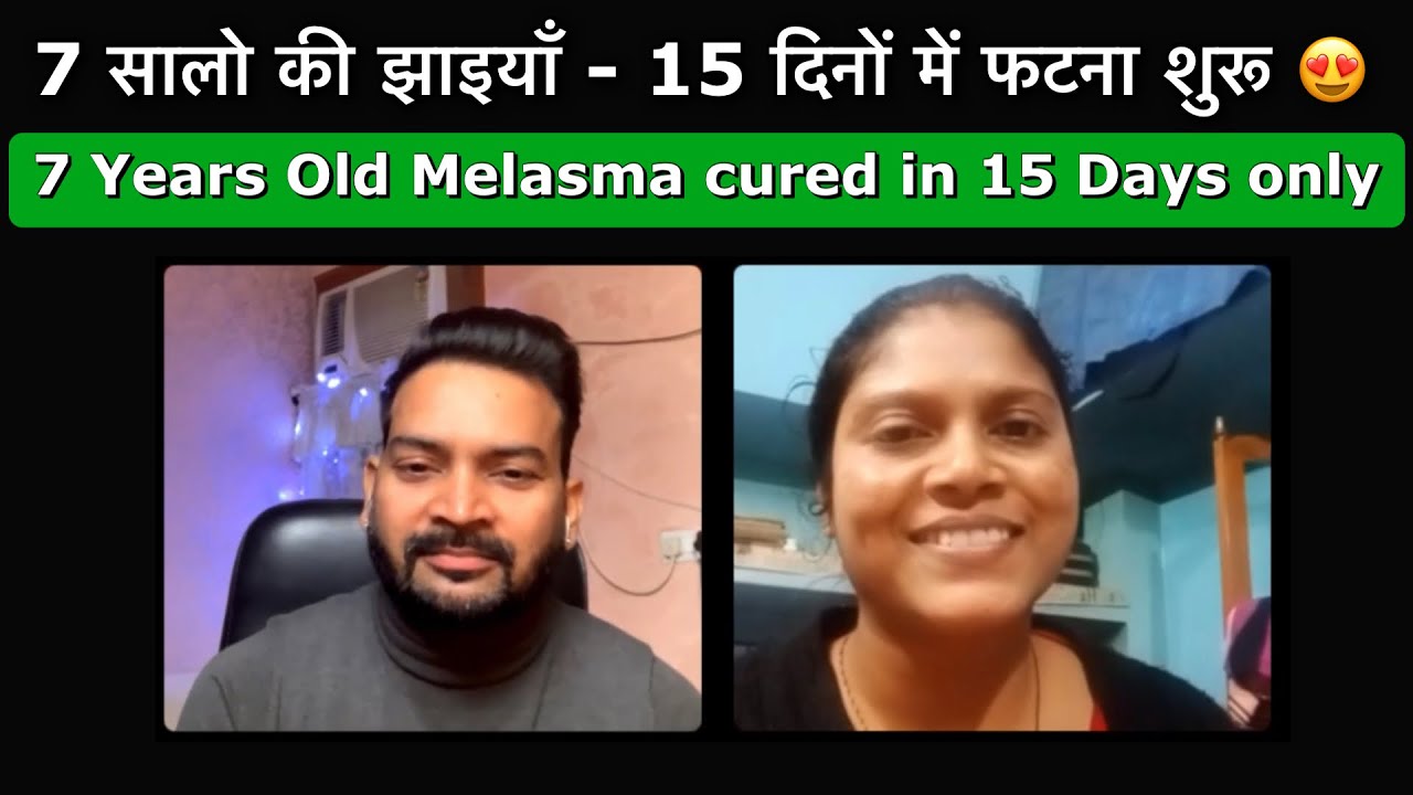 7 सालो की झाइयाँ - 15 दिनों में फटना शुरू 😍 My 7 Years Old Melasma Gone in 15 Days