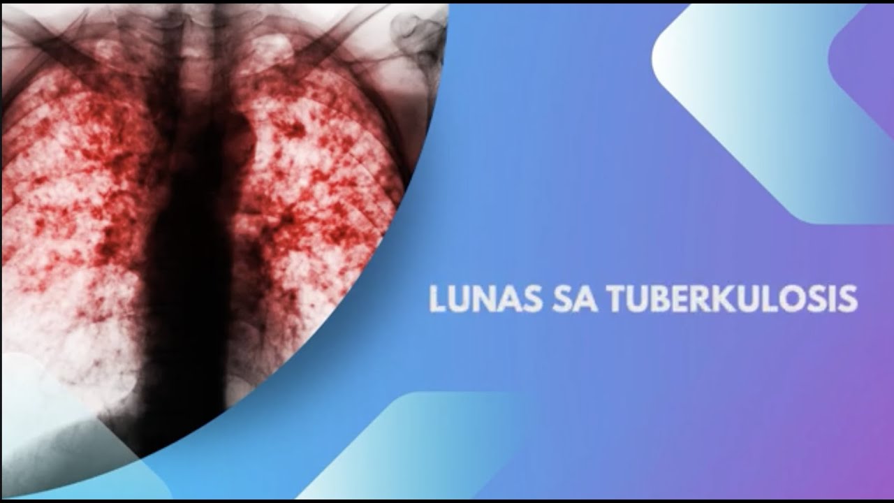 TUBERKULOSIS: Tamang Paraan para Tuluyang Magamot