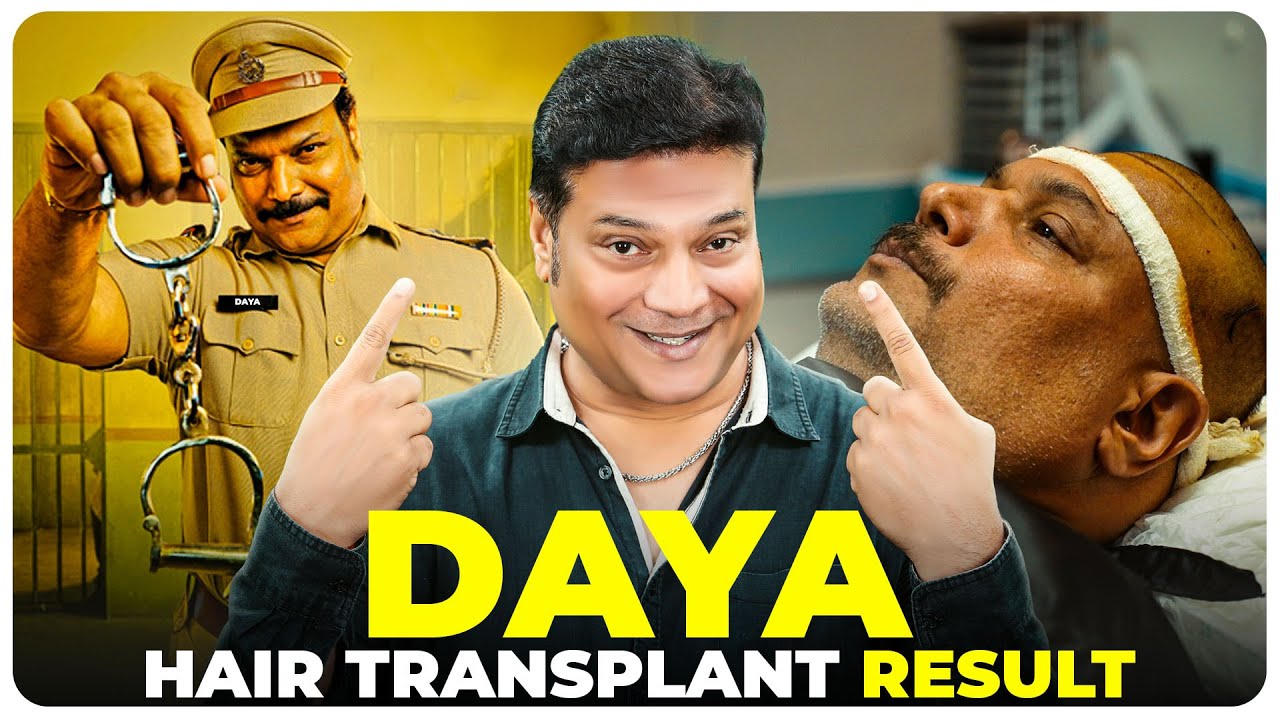 Hair Transplant Results | Success Story of Bollywood Actor Daya With Best Hair Transplant Result