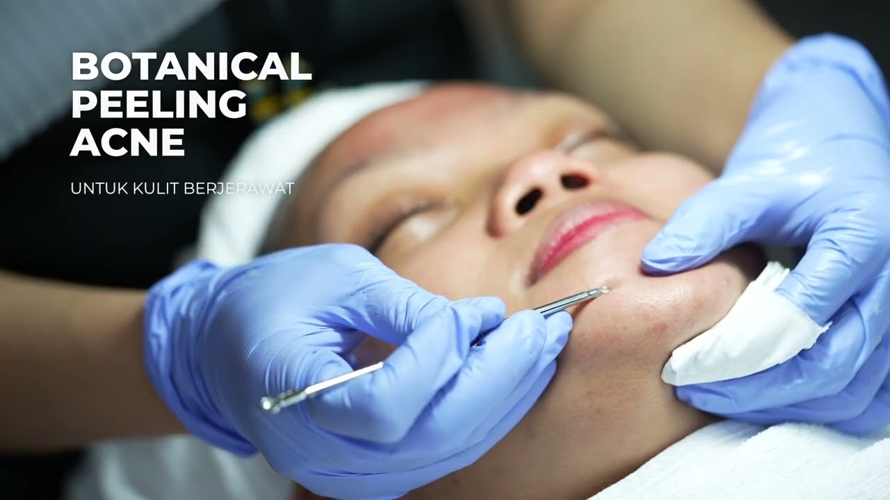 PERAWATAN UNTUK KULIT BERJERAWAT DI NATASHA SKIN CLINIC CENTER