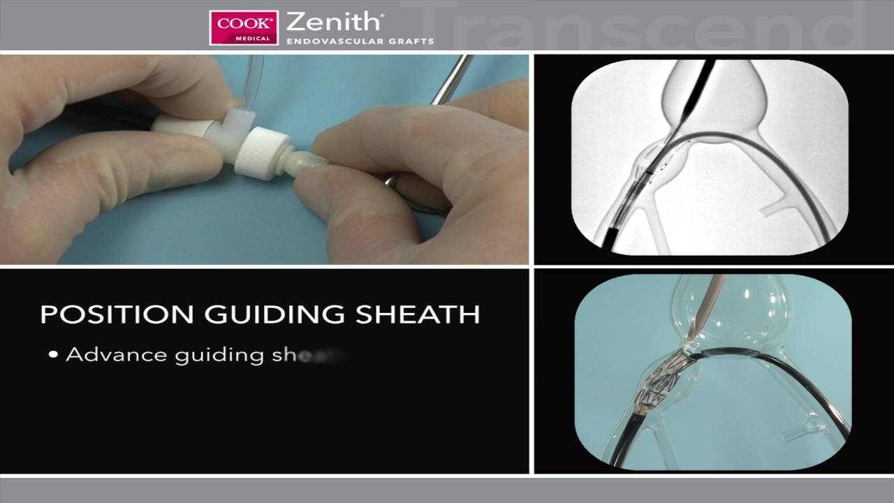 Iliac Branched device (IBD)