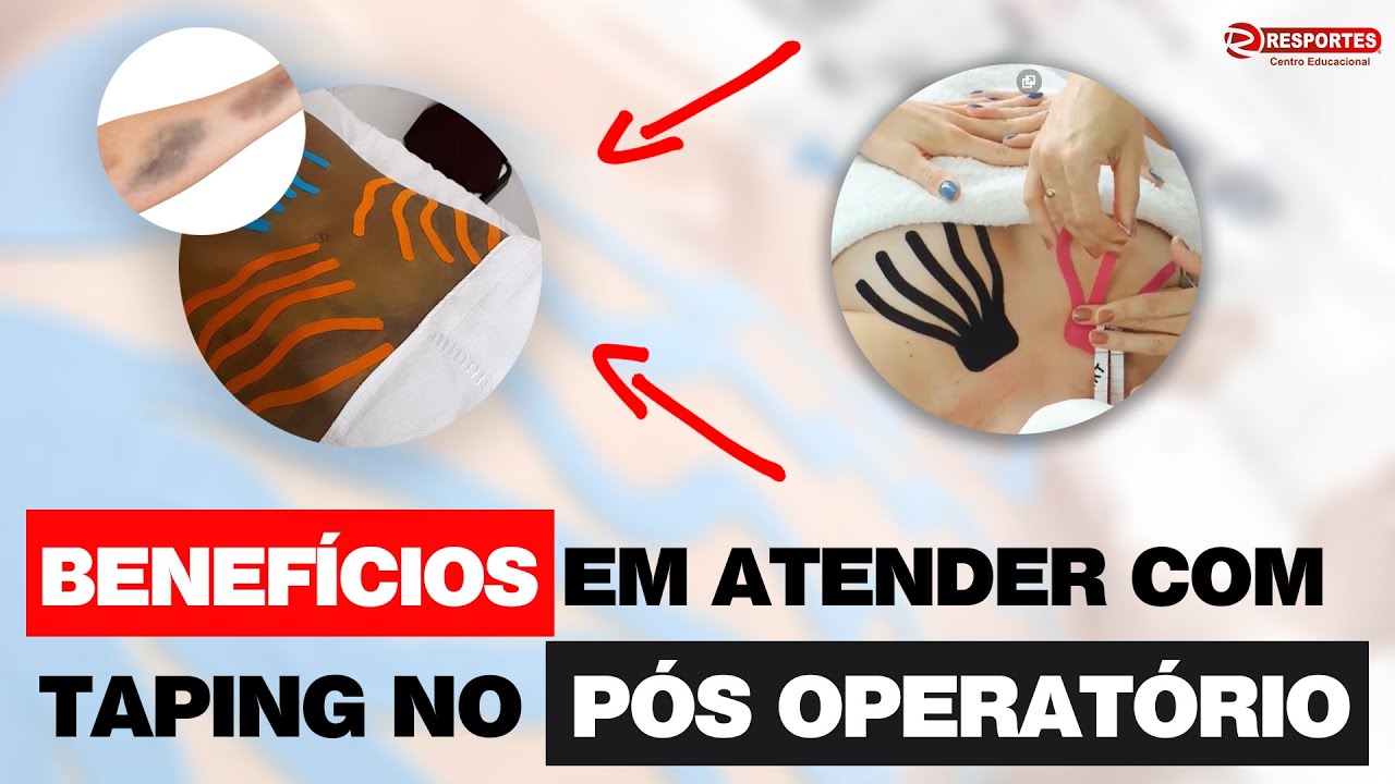 5 motivos para aplicar o TAPING no PÓS OPERATÓRIO!