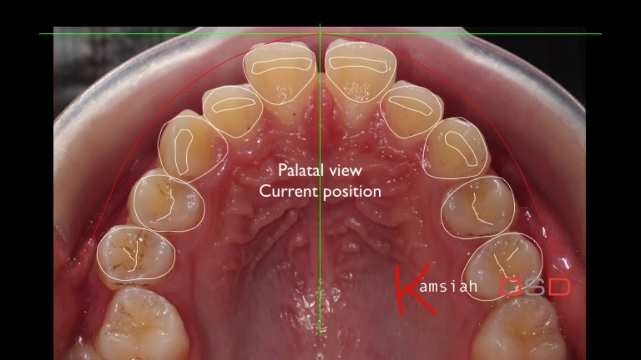 Digital Smile Design In Orthodontics