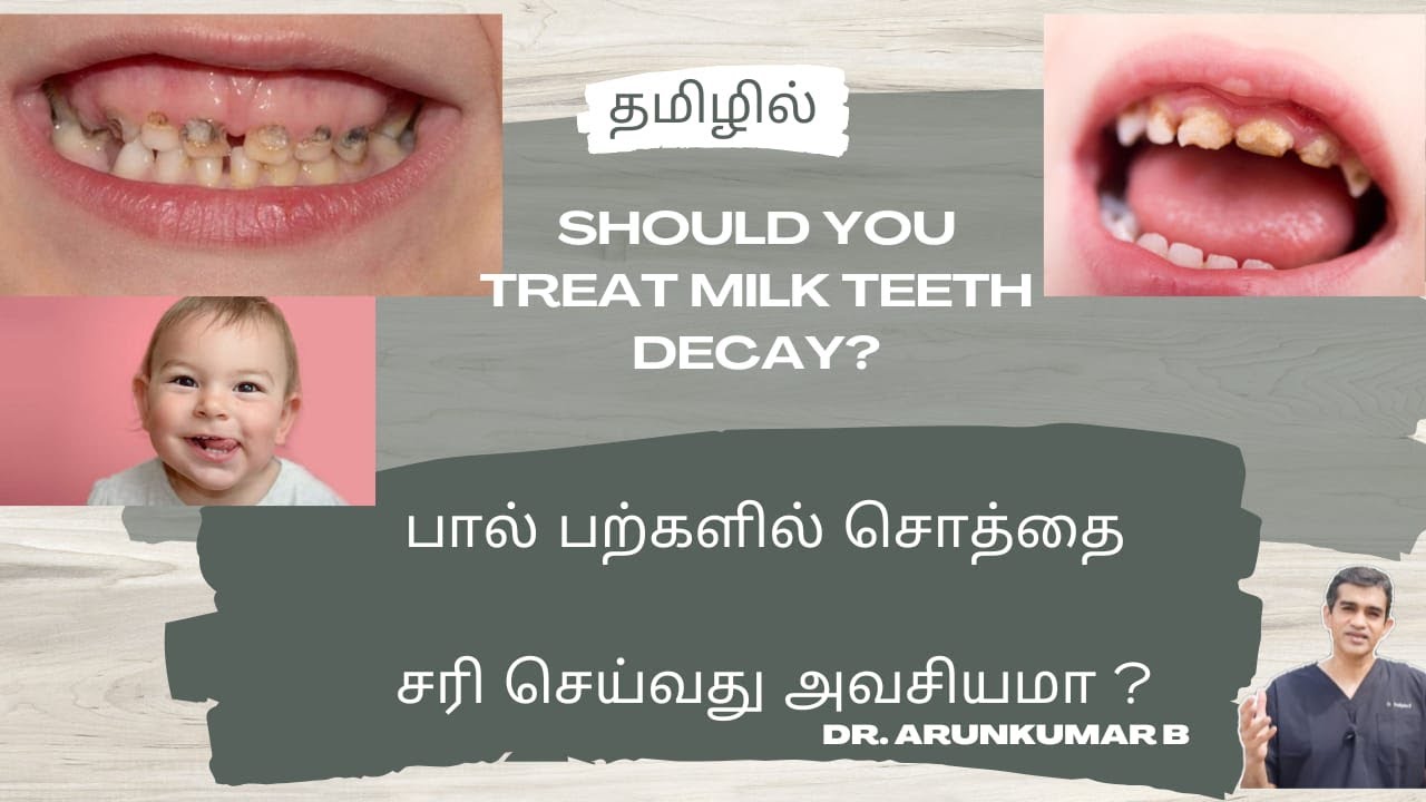 பால் பற்களில் சொத்தை சரிசெய்வது அவசியமா? | Milk Teeth Decay | Dr Arunkumar Pearls Dentistry Chennai