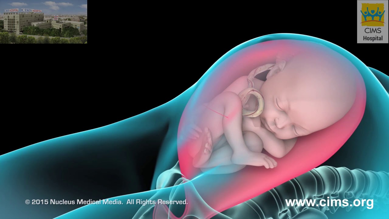 Cesarean Section Delivery – CIMS Hospital
