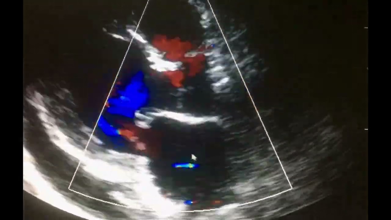 Ecocardiograma: Complicaciones del Infarto al miocardio