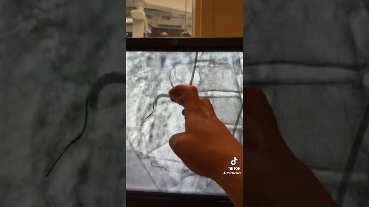 Dr.Hamo, Nightmare of the Cath Lab! A Spiral Dissection and perforation of RCA!  Successful PCI !
