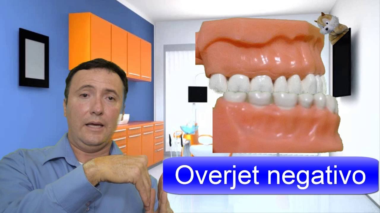 Oclusión Overjet