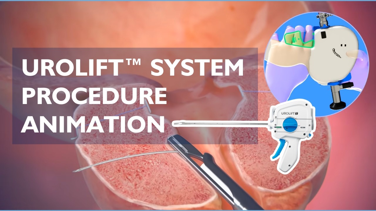 UroLift™ System Procedure Animation