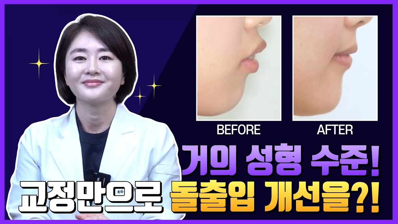 거의 성형 수준! 교정만으로 돌출입 개선을?!👀