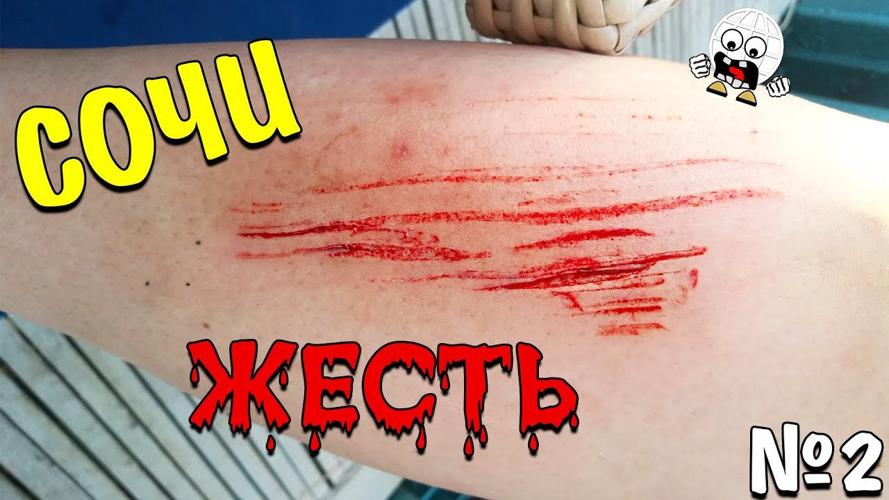 УЖАСЫ СОЧИ! У спасателей нет аптечки! Отдых на Чёрном Море