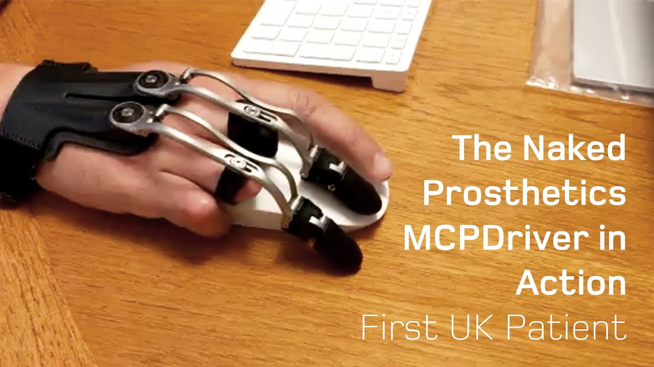 The Naked Prosthetics MCPDriver in Action | First UK Patient