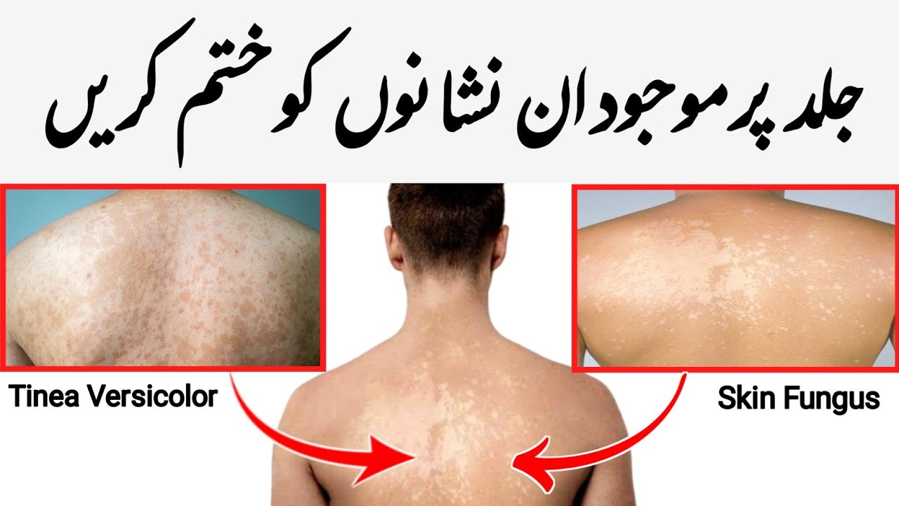 Tinea Versicolor Treatment - Tinea Versicolor Kya Hai - Fungal Infection Ka Ilaj