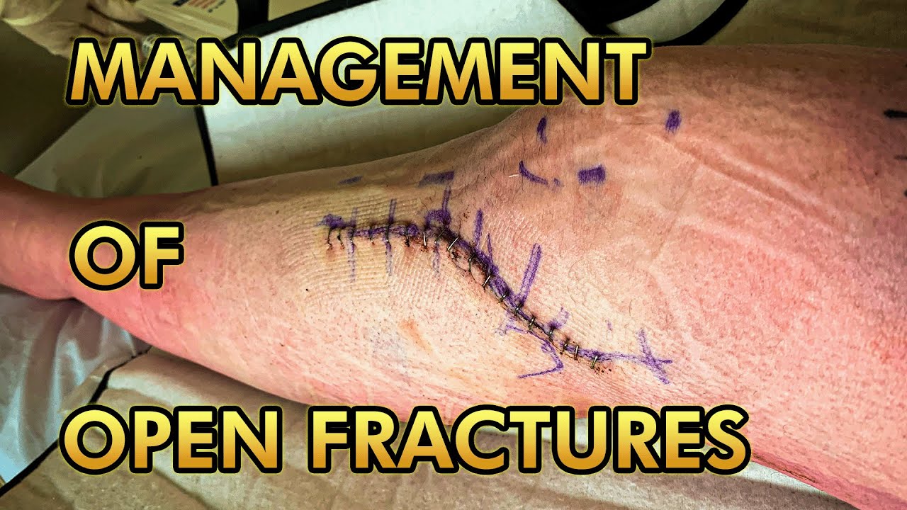 Open Fracture Treatment: Wound Debridement, Fracture Stabilization and Soft Tissue Reconstruction