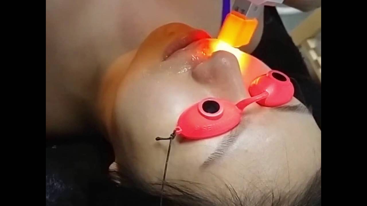 Bubble Gum Wax :  IPL Upper Lip Treatment
