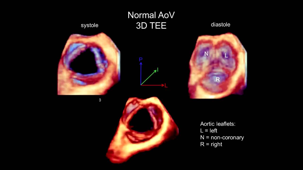 3D Echocardiography Acquisition, Cropping, and Case Examples