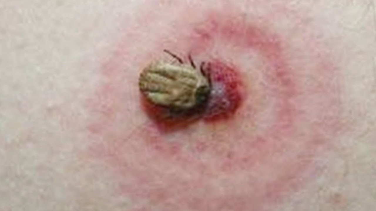 Health Officials Warn Of Deer Ticks Over Fourth Of July