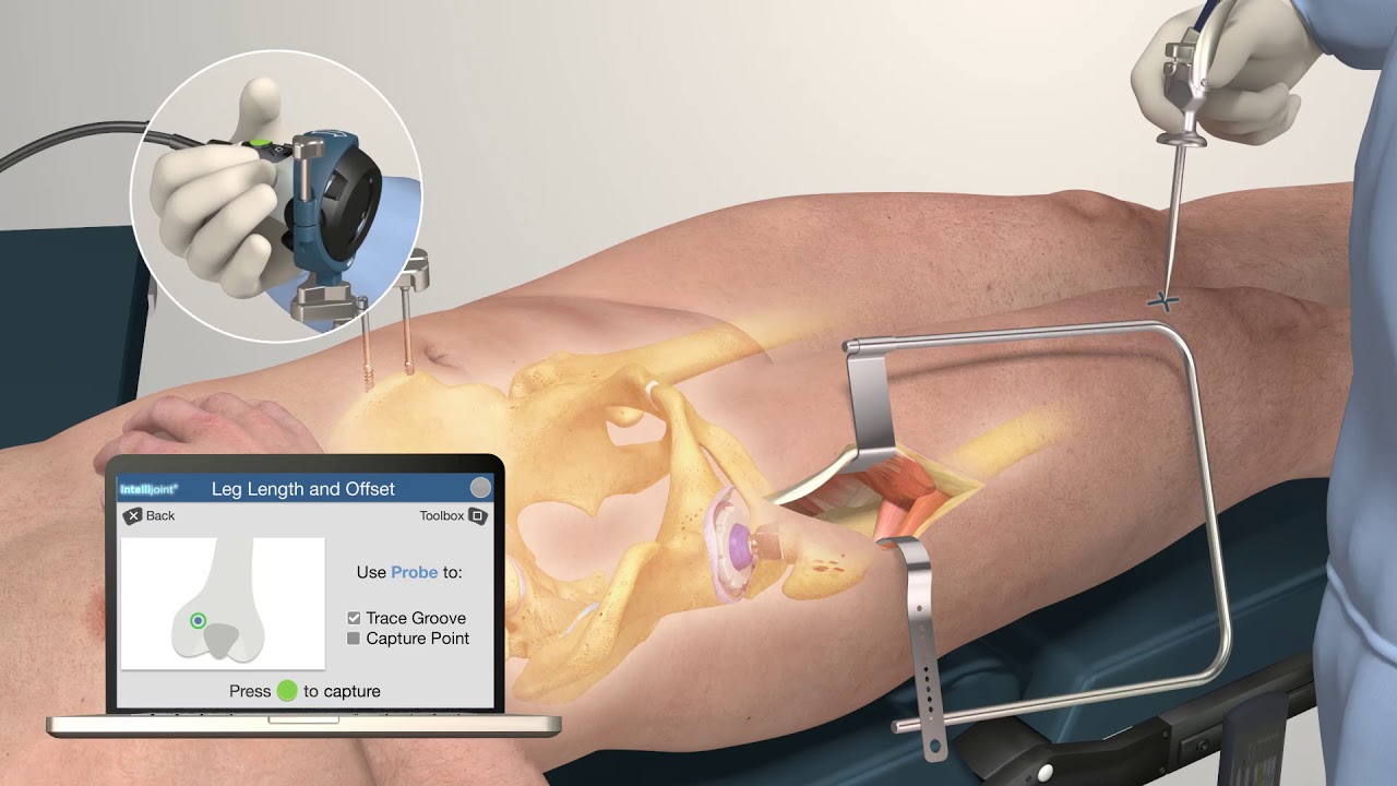 Intellijoint HIP Anterior by Intellijoint Surgical Inc