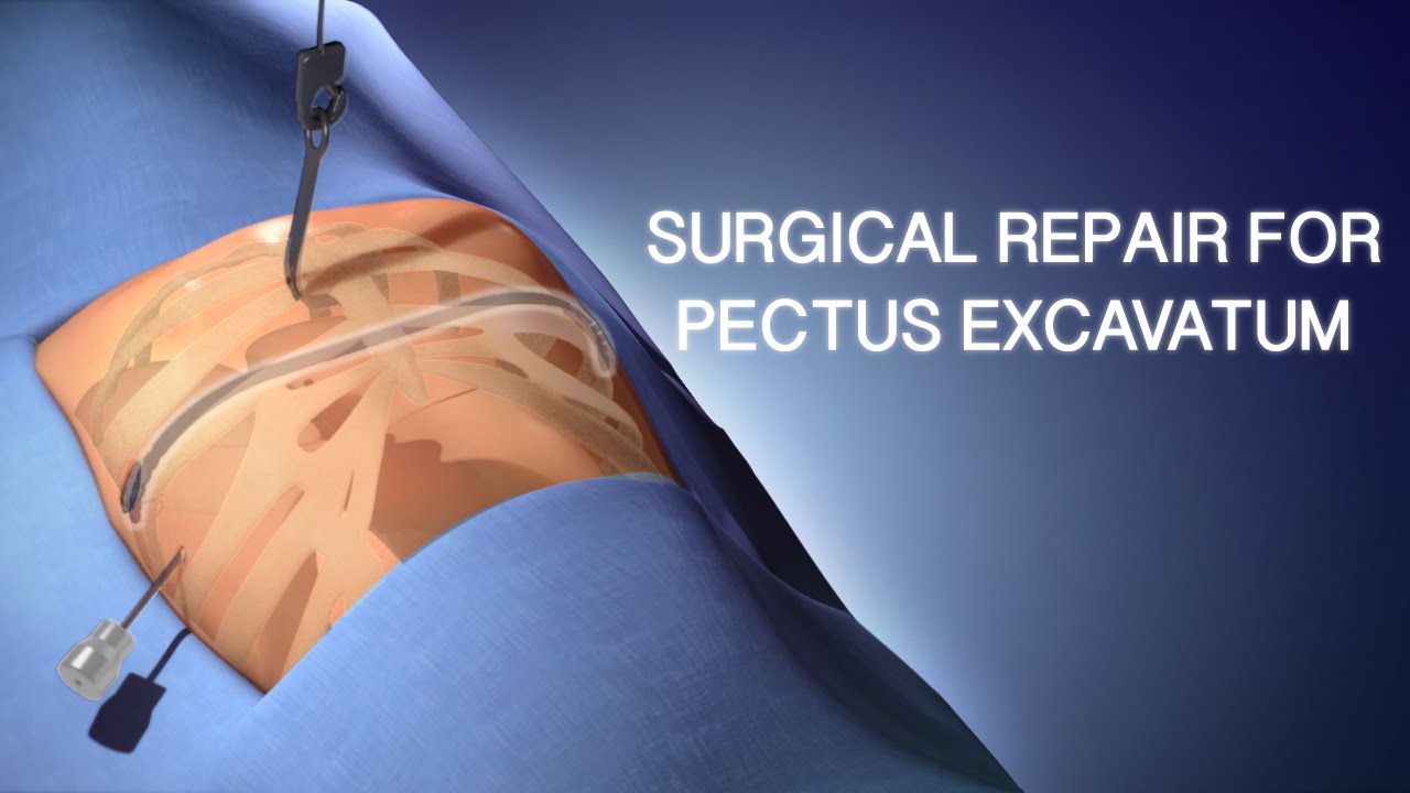 Pectus Excavatum Surgical Repair | A Cincinnati Children's Medical Animation