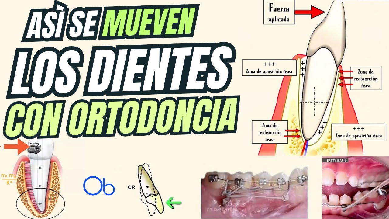 ¿Cómo se mueven los dientes en Ortodoncia? 🦷 