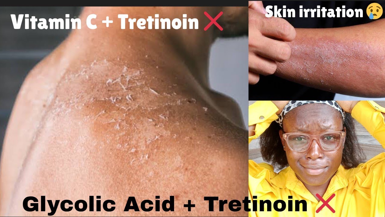 You Have Being Layering Your Acids Wrong! Here's how to do it safely 
