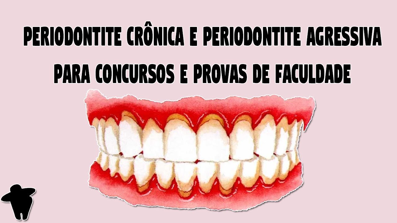 Classificação das Doenças Periodontais - Periodontite Crônica e Periodontite Agressiva [DE #7]