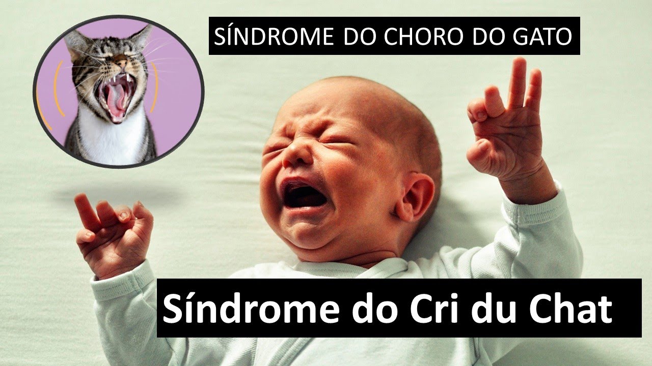 Síndrome do Cri du Chat - Síndrome do Choro do Gato.