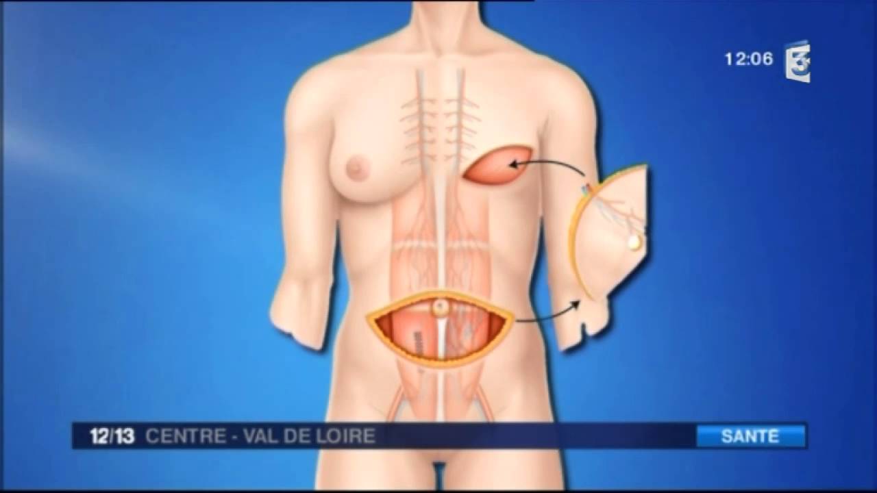 Reconstruction mammaire avec la méthode DIEP