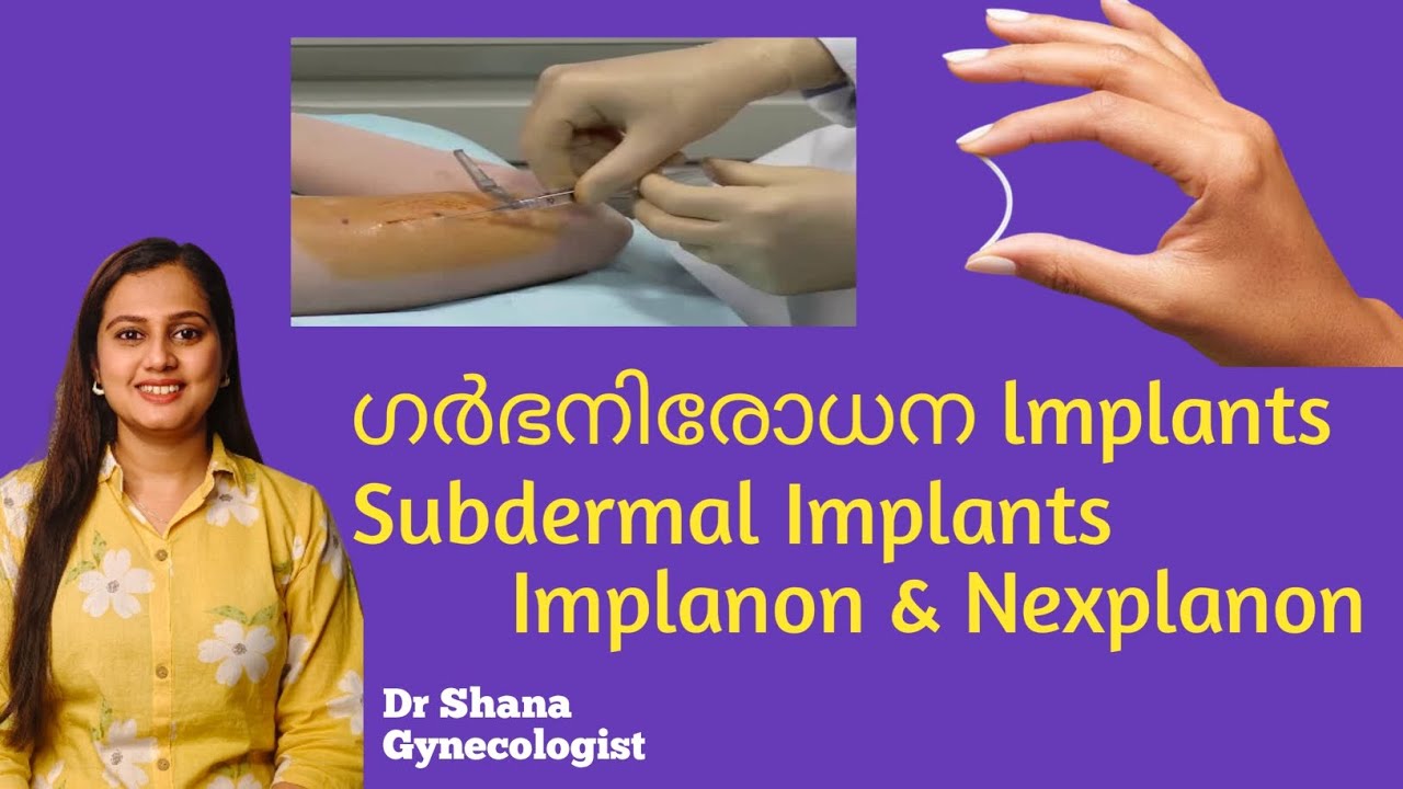 ഗർഭനിരോധന Implants Subdermal Implants Implanon & Nexplanon 