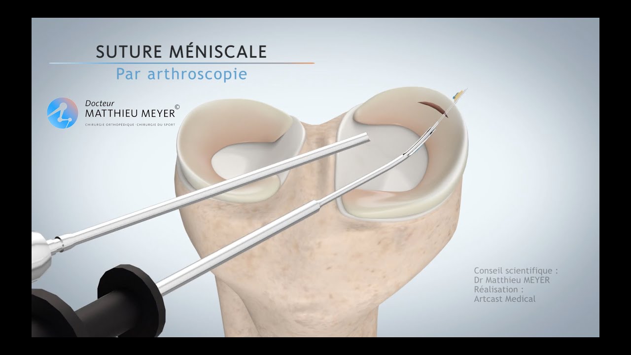 SUTURE MÉNISCALE PAR ARTHROSCOPIE - DR MATTHIEU MEYER