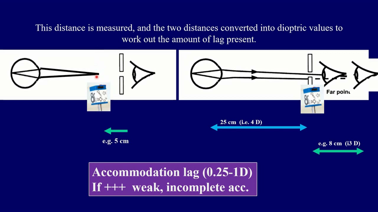 Optics course : Dynamic retinoscopy