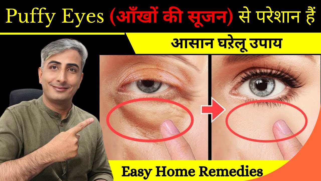 Puffy Eyes (आँखों की सूजन) से परेशान हैं I आसान घऱेलू उपाय I Easy Home Remedies I DR. MANOJ DAS