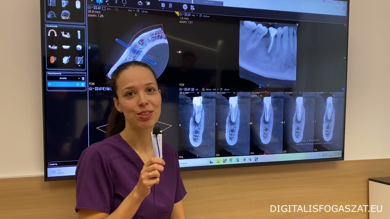 🦷Gyökérkezelés, gyökértömés