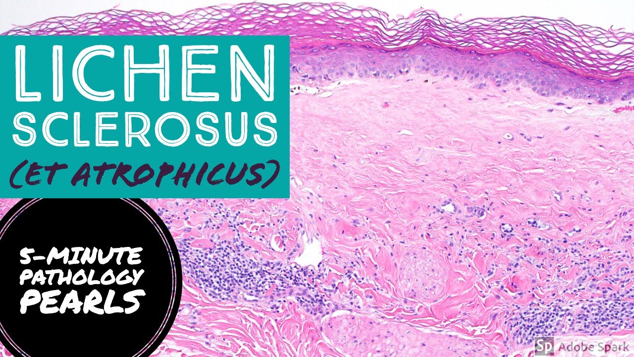 Lichen Sclerosus et Atrophicus: 5-Minute Pathology Pearls