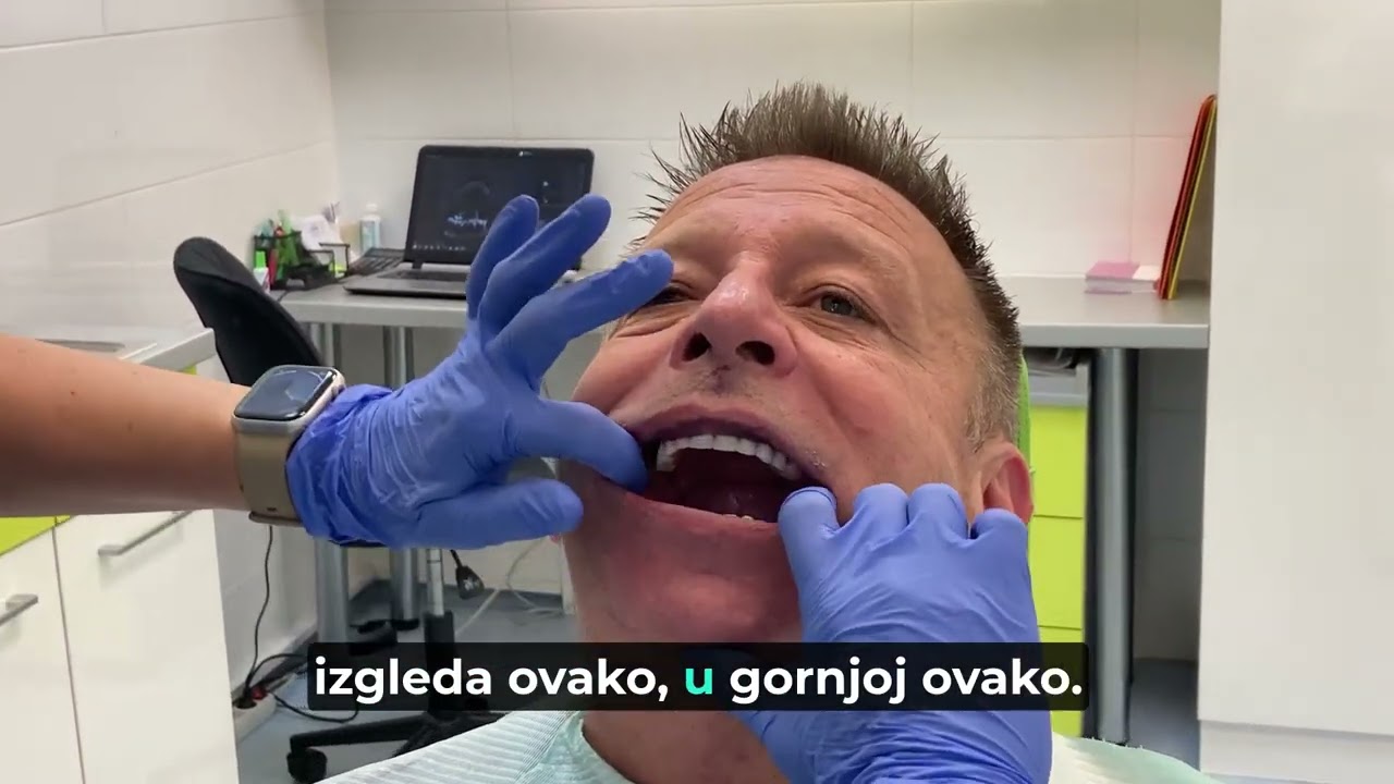 All on 4 zbog uznapredovale paradontopatije