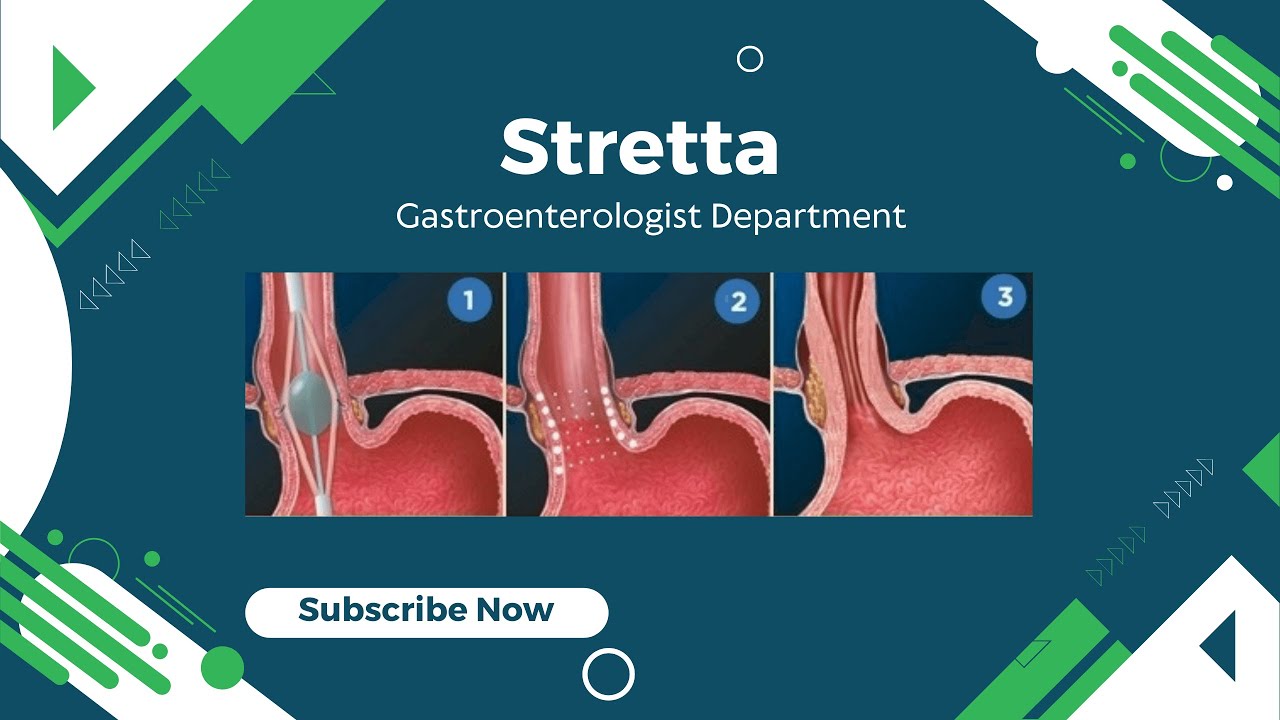 Stretta Treatment