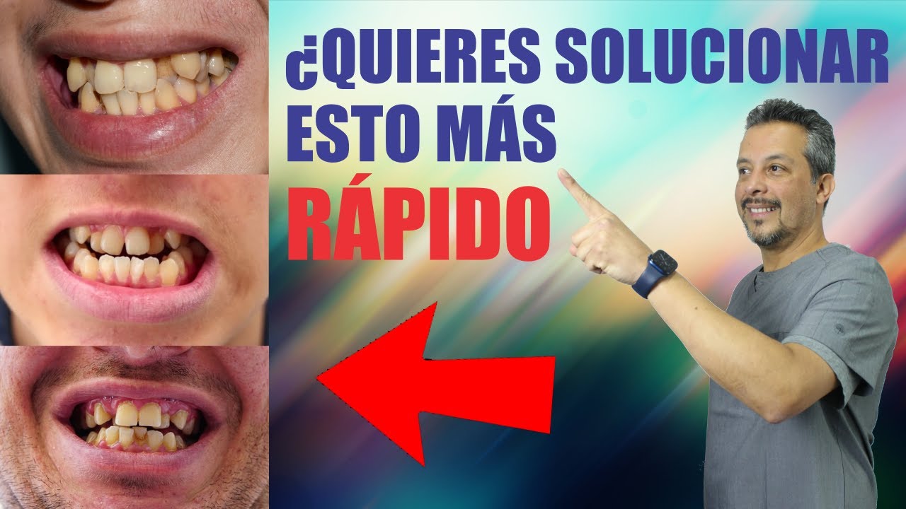 Los DIENTES más CHUECOS 🦷 RESUELTOS con INVISALIGN 🤩 SANTIAGO BURGA 3D digital dental design